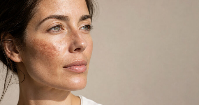 Woman with facial melasma and and hyperpigmentation, natural skin texture. For skincare, dermatology, beauty, and beauty awareness.