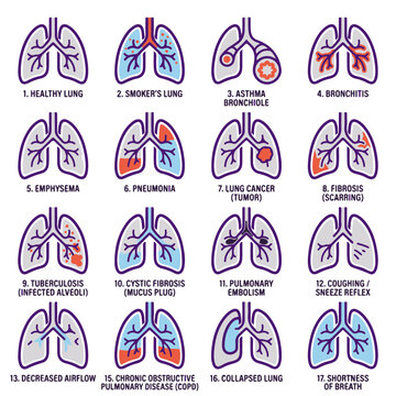 Human Lung Diseases and Conditions Vector Illustrations for Education