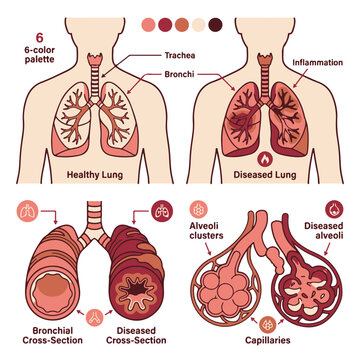 Human Respiratory System Comparison Healthy Versus Diseased Lungs Illustration