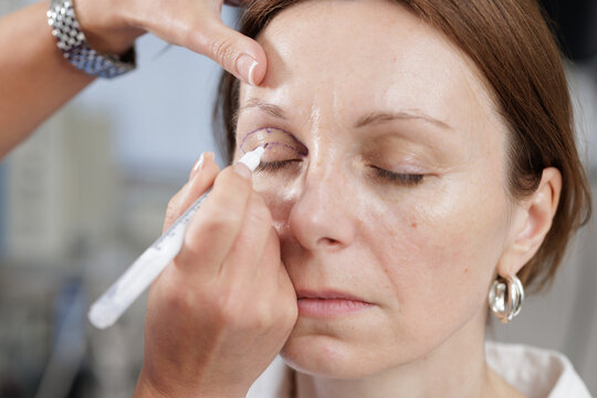 Modern Blepharoplasty Procedure for Eyelid Rejuvenation in Aesthetic Surgery