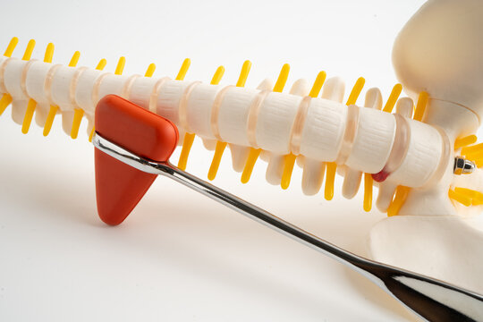 Human spinal nerve and bone with percussion reflex hammer, model for treatment medical in the orthopedic department.