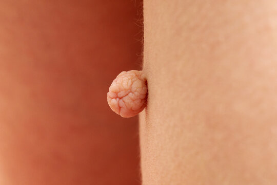 Soft fibroma. Acrochordon. Large round papilloma, benign mole on the body. Medical examination. Close-up.