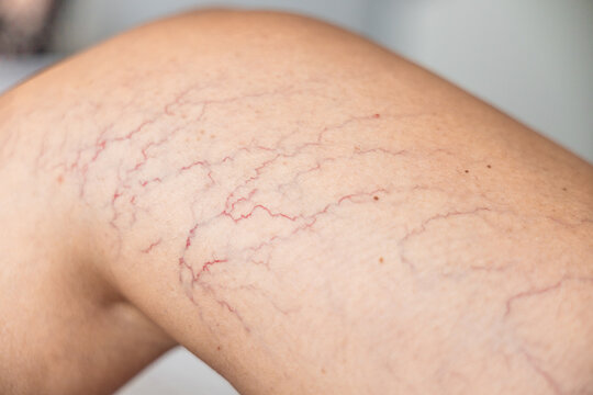 Close-up of lower leg with spider veins and superficial telangiectasia. Visible vascular changes associated with chronic venous disease, phlebology, vascular diagnostics, prevention, and medical healt