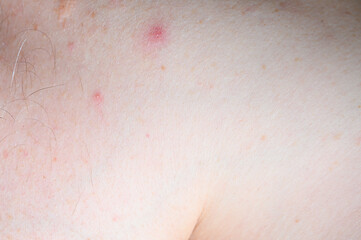 Fototapeta premium Close-up of fair skin with red blemishes, irritated spot and fine hair follicles