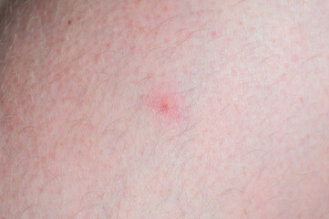 Fototapeta premium Close-up of fair skin showing a small red irritated spot and fine hairs