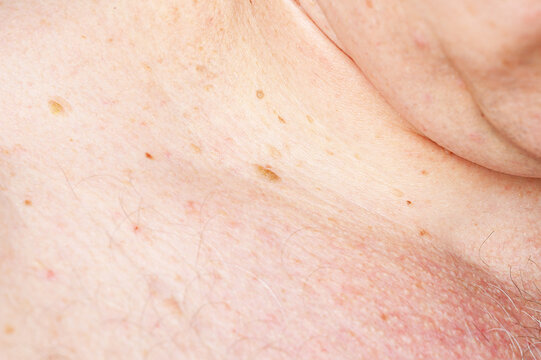Close-up of aging skin with multiple skin tags and moles on chest area