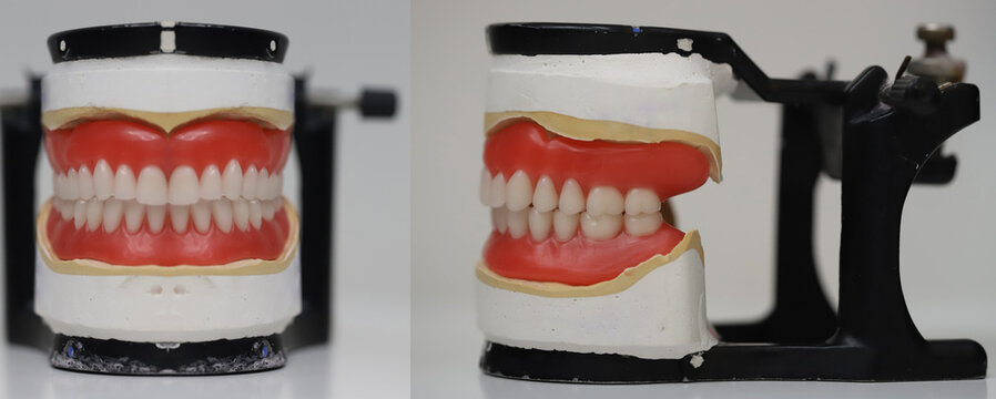 Full arch complete denture designed for edentulous jaws in dental dentistry. Removable dental prosthesis denture.
