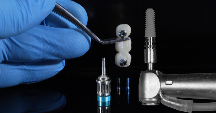 Titanium endosseous implant as an edentulism treatment in dental dentistry. Dental implant with artificial tooth roots and implant supported porcelain prosthesis crown treatment.