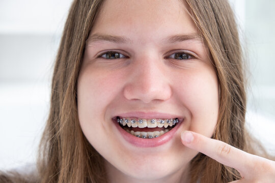 Cute teenage girl smiling pointing finger at her dental braces, close up. Orthodontic treatment concept