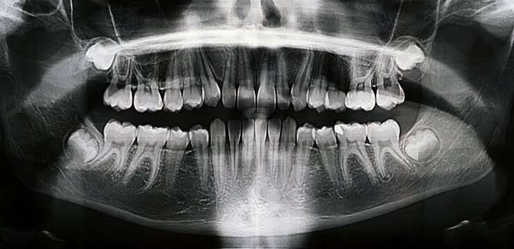 Panoramic X-ray of the jaw. X-ray of the teeth of a 12-year-old girl