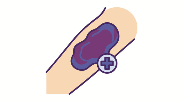 Flat vector illustration of bruised arm with purple bruise mark.eps