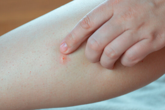 hand with clean fingernails gently touches an inflamed insect bite on the skin of a leg in a detailed closeup showing the small red bump and pore concept of dermatology, first aid, healthcare