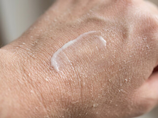 Fototapeta premium Close up of moisturizing cream being applied to dry flaky skin on hand.