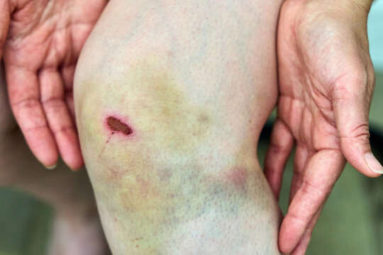 Scraped knee on a female leg with a large healing yellowish-purple bruise and a small bloody wound, close up.