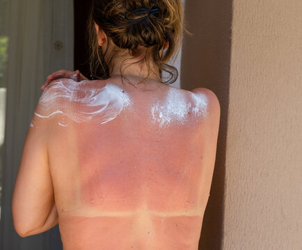 Woman applying panthenol spray to her sunburned back, shoulders after prolonged sun exposure. Soothing irritated skin, relieving discomfort and supporting recovery. Vacation, UV damage, skin health.