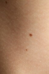 Fototapeta premium Texture of normal skin with birthmarks as background, closeup