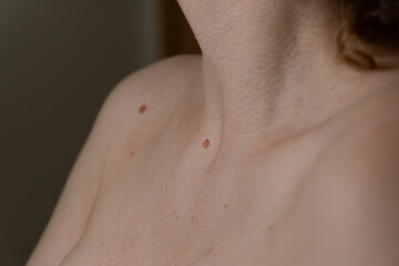 Fototapeta premium Close-Up of Human Skin Texture with Benign Moles on Neck and Collarbone, Dermatology and Skin Health Concept