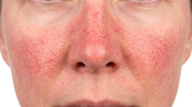 Erythematotelangiectatic Rosacea Flushed Nose and Cheeks with Visible Capillaries