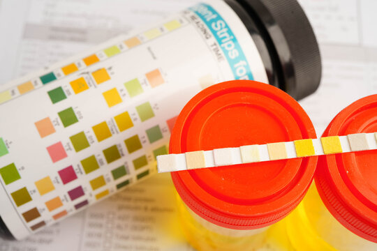 Urinalysis, urine cup with reagent strip pH paper test and comparison chart in laboratory.