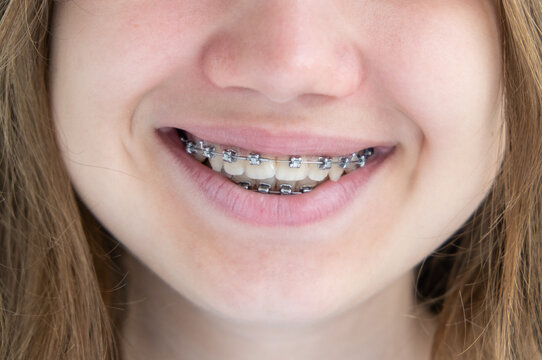 Close up smile of teenage girl with metal dental braces on teeth. Orthodontics and dentistry concept.