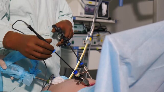 Close-up of surgeon hands performing laparoscopic surgery using endoscopic instruments on patient covered with blue sterile drape in operating room, Professional mwdical content. 4k video