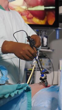 Laparoscopic surgery in operating theatre. Vertical footage. Minimally Invasive Surgery with Advanced Technology. advanced medical equipment. Laparoscopic cholecystectomy tools. 4 k video