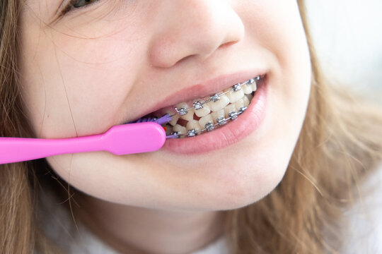 Close up teen girl with braces brushing her teeth with toothbrush. Dental and oral care for kids. Selective focus