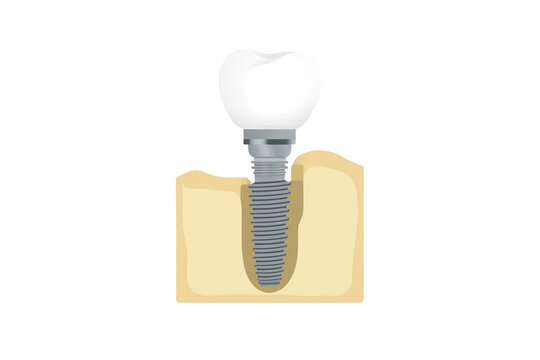 Dental implant structure showing crown, abutment, and screw-shaped post embedded in jawbone for artificial tooth replacement or oral surgery