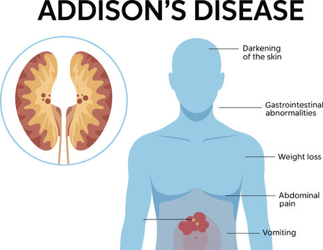 Addison's Disease Medical Vector Illustration Showing Adrenal Gland Disorder Symptoms with Human Body Anatomy Endocrine System Healthcare Educational Diagram