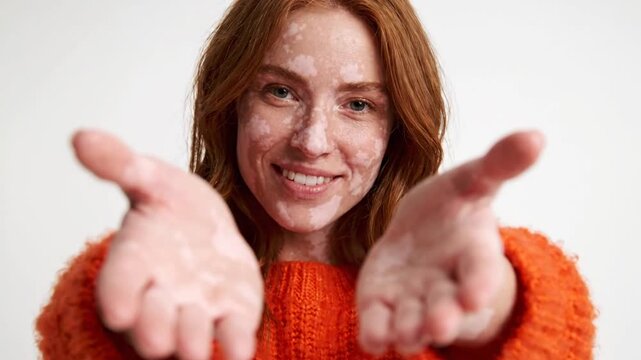 Joyful woman with vitiligo extending hands towards camera, embracing inclusivity and diversity
