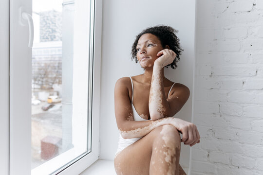 Woman with vitiligo looking through glass window at home