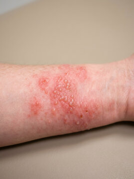 Contact dermatitis on the skin of a human arm. Close-up view of red, inflamed, itchy blistered skin rash. Medical illustration of allergic skin reaction and health problem.