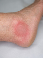 Fototapeta premium Rash on the ankle of a man. Skin irritation with red inflammation and patch of dry texture. Medical symptom of contact dermatitis or allergy. Healthcare issue and skin condition.