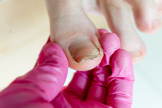 Closeup of a physician removing a damaged nail from an injured toe on a big toe. A focused doctor uses forceps extracting an infected nail and ingrown nail in a sterile podiatry treatment room.
