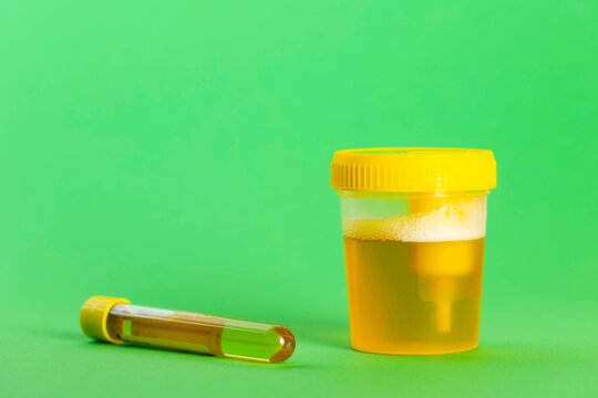 A test tube with reagent and urine on a green background. Bacterial culture for Enterobacteriaceae and Staphylococcus saprophyticus bacteria, which cause pain and inflammation in the urinary tract. 