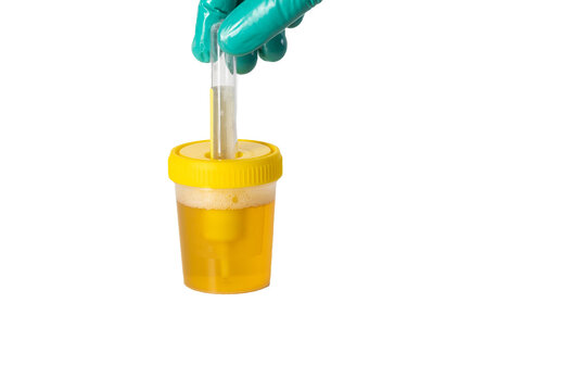 Transferring urine into a transport tube with reagents for bacterial culture testing, white background. Diagnosis of bacterial infections and microorganisms with antibiotic sensitivity. 