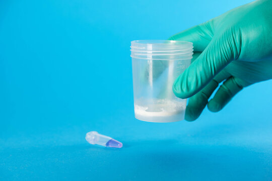 A doctor holds a medical container with ejaculate in his hand against a blue background. Conceptual illustration of a spermogram test for sperm motility and the male reproductive system. 