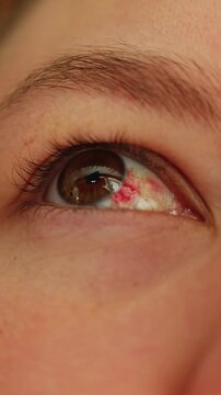 Close up of human eye with subconjunctival hemorrhage showing red blood spot
