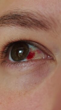 Close-up of human eye with subconjunctival hemorrhage and blinking motion