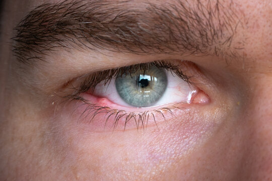 Hordeolum or stye close-up. Bacterial infection of oil gland in eyelid of male caucasian person. Inflammation and swollen area causing a lump under the eye. Face with eyebrow, eyelashes and skin.