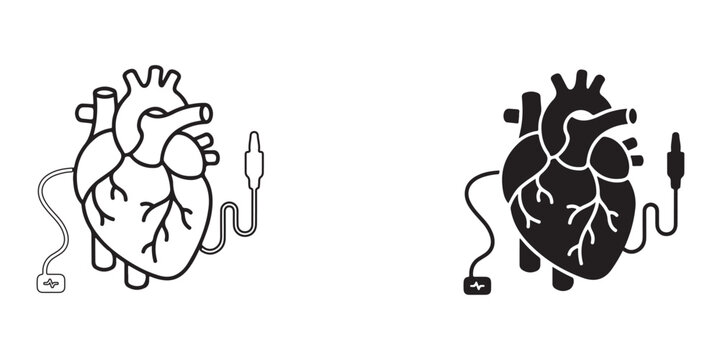 Medical illustration showing heart pacemaker implantation with defibrillator and ECG monitoring devices