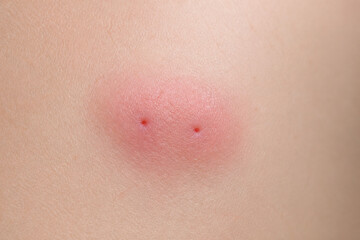 Fototapeta premium Close up of mild fang puncture marks on skin