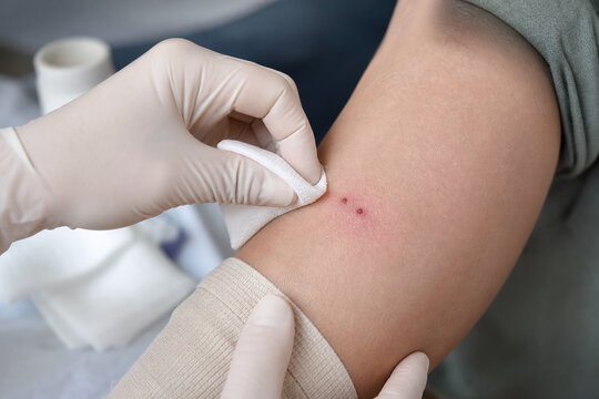 First aid cleaning of snakebite puncture wound