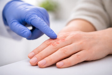 Fototapeta premium Healthcare professional examining irritated skin on a patient's hand during dermatology consultation