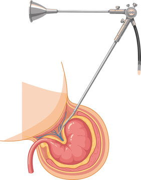 Endoscopic view of stomach with inserted gastroscope and anatomical illustration Keywords: stomach, endoscopy, gastroscope, medical