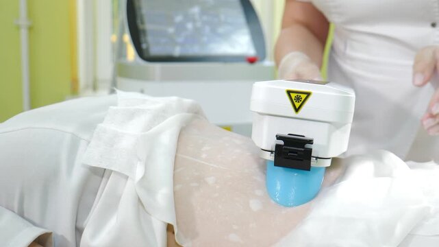 Cosmetologist adjusting cryolipolysis applicator with yellow warning label on patient abdomen. Non-invasive cold fat reduction procedure during beauty clinic treatment session. Body care 4k video