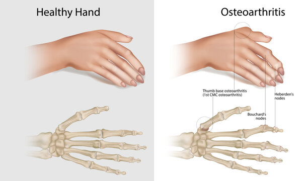 Healthy Hand vs Osteoarthritis Comparison with Heberden's Nodes, Bouchard's Nodes and Thumb Base Osteoarthritis Medical Illustration