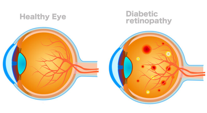 Diabetic retinopathy structure, anatomy. Blood vessels in eye swell and leak blood into the retina. Retina, sclera, conjunctiva optic nerve, include, cornea. Illustration vector
