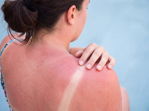 Severe Sunburn on Young Woman's Shoulder with Clear Swimsuit Tan Line Close-Up