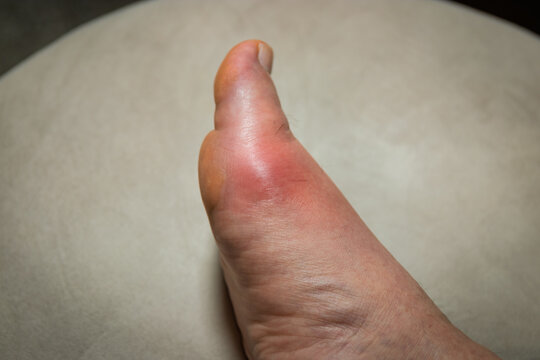 Painful red swollen toe joint illustrating inflammation, joint pain, and podiatry condition